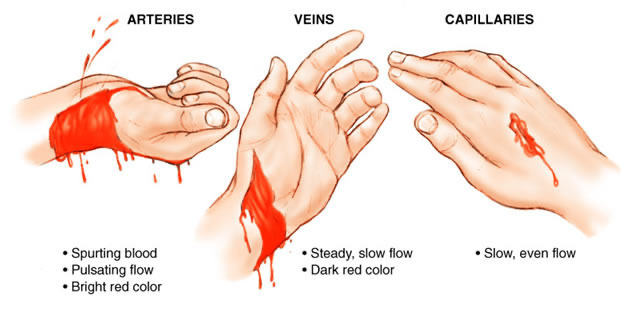 Diagram of showing the diffrence between arterial, venous, and capillary bleeding.